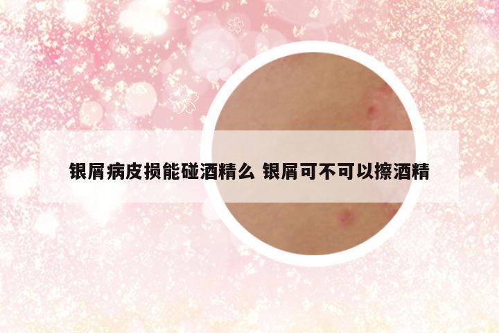 银屑病皮损能碰酒精么 银屑可不可以擦酒精
