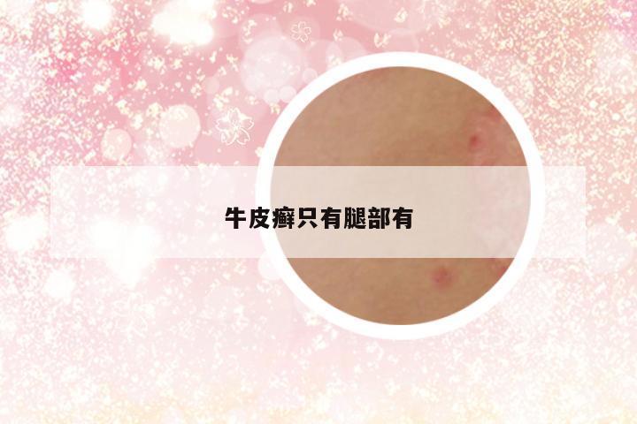 牛皮癣只有腿部有