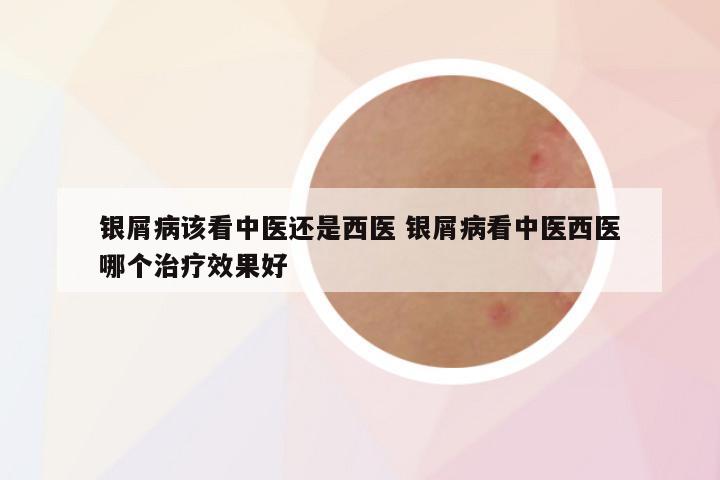 银屑病该看中医还是西医 银屑病看中医西医哪个治疗效果好