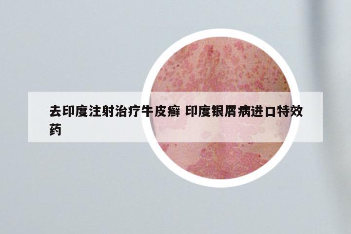去印度注射治疗牛皮癣 印度银屑病进口特效药