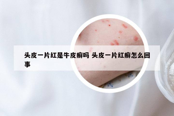 头皮一片红是牛皮癣吗 头皮一片红癣怎么回事