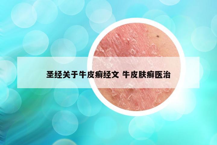 圣经关于牛皮癣经文 牛皮肤癣医治