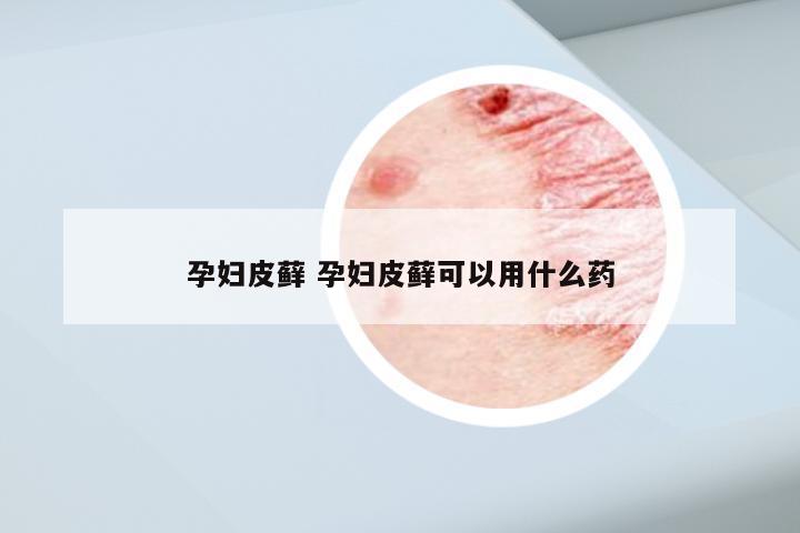 孕妇皮藓 孕妇皮藓可以用什么药