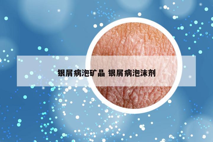 银屑病泡矿晶 银屑病泡沫剂
