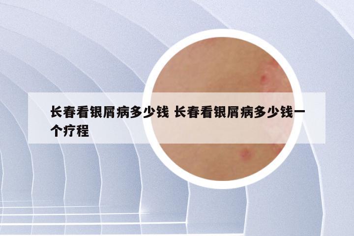 长春看银屑病多少钱 长春看银屑病多少钱一个疗程