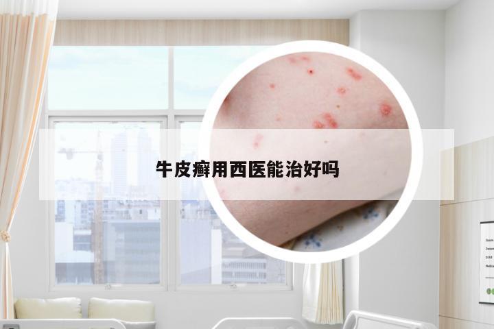 牛皮癣用西医能治好吗