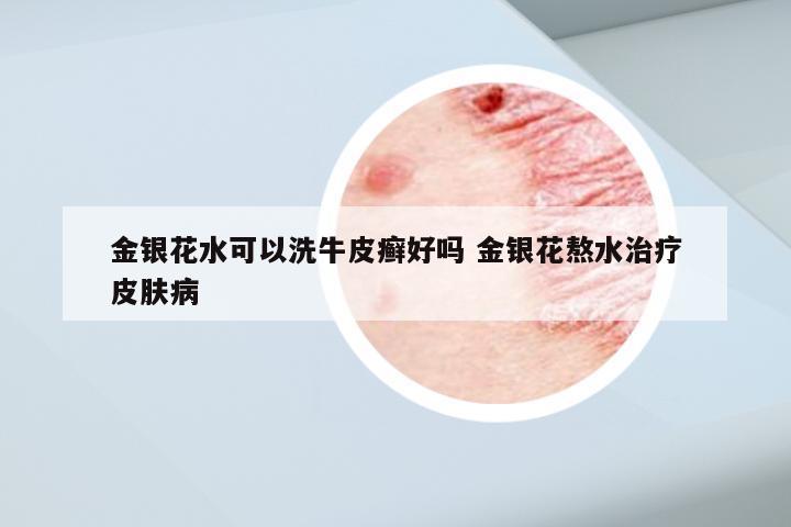 金银花水可以洗牛皮癣好吗 金银花熬水治疗皮肤病