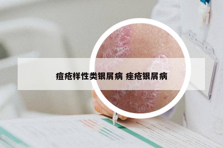 痘疮样性类银屑病 痤疮银屑病