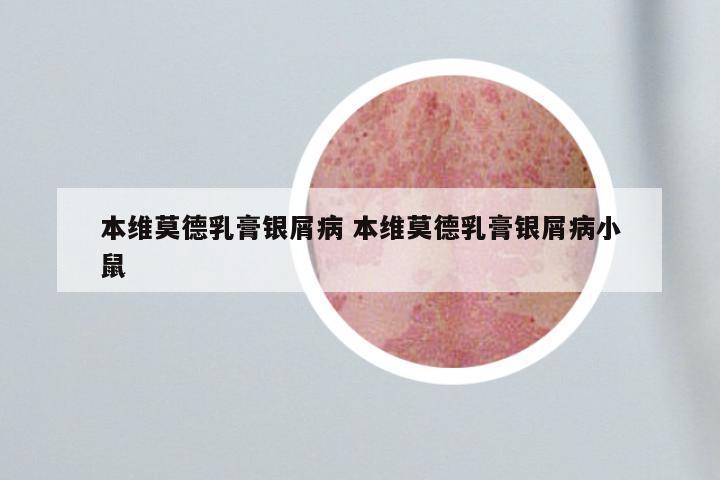 本维莫德乳膏银屑病 本维莫德乳膏银屑病小鼠