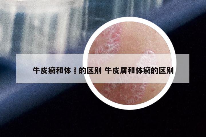 牛皮癣和体廯的区别 牛皮屑和体癣的区别