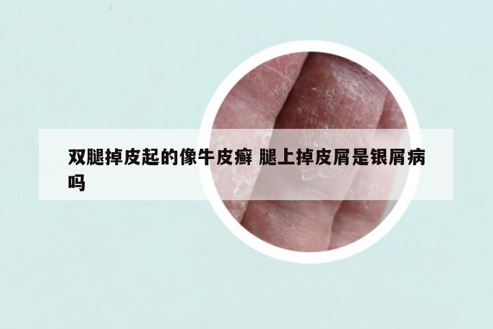 双腿掉皮起的像牛皮癣 腿上掉皮屑是银屑病吗
