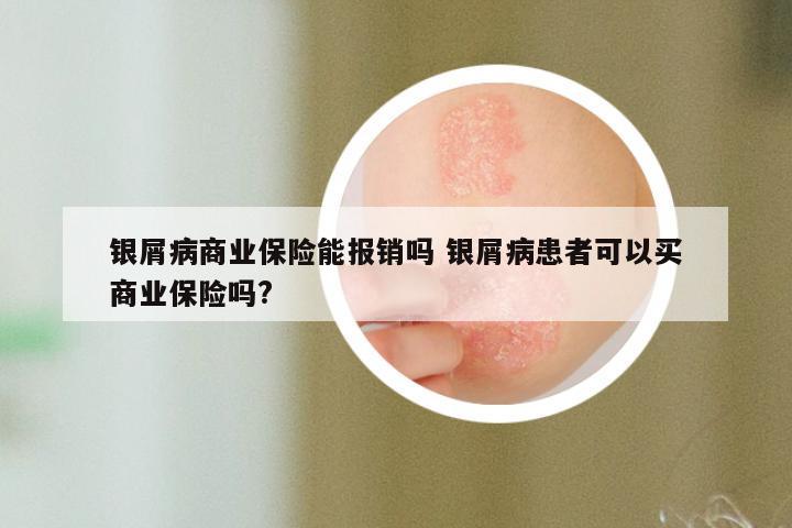 银屑病商业保险能报销吗 银屑病患者可以买商业保险吗?