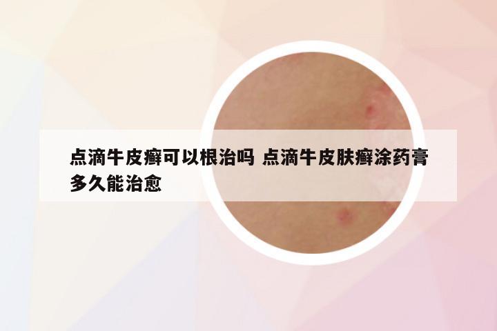 点滴牛皮癣可以根治吗 点滴牛皮肤癣涂药膏多久能治愈