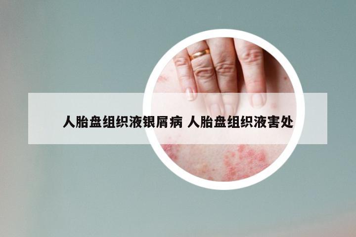 人胎盘组织液银屑病 人胎盘组织液害处