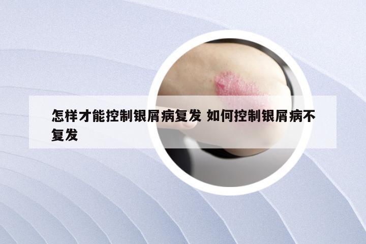 怎样才能控制银屑病复发 如何控制银屑病不复发