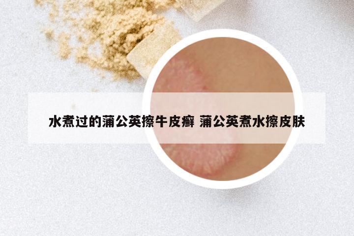 水煮过的蒲公英擦牛皮癣 蒲公英煮水擦皮肤