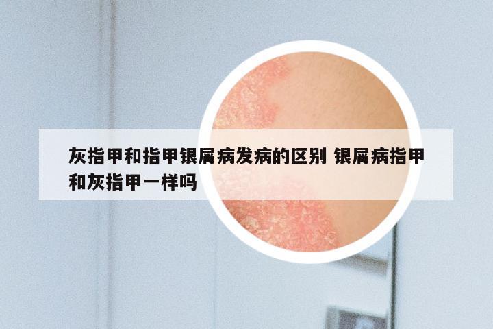 灰指甲和指甲银屑病发病的区别 银屑病指甲和灰指甲一样吗