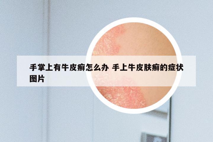 手掌上有牛皮癣怎么办 手上牛皮肤癣的症状图片