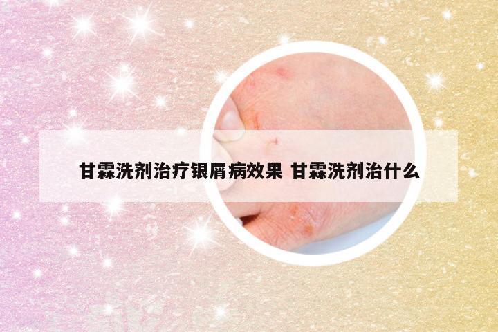 甘霖洗剂治疗银屑病效果 甘霖洗剂治什么