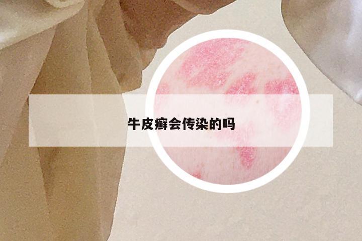 牛皮癣会传染的吗