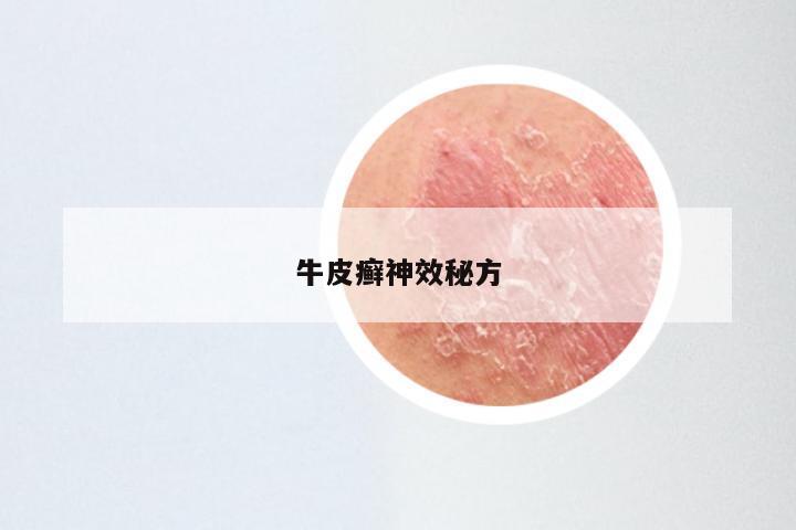 牛皮癣神效秘方