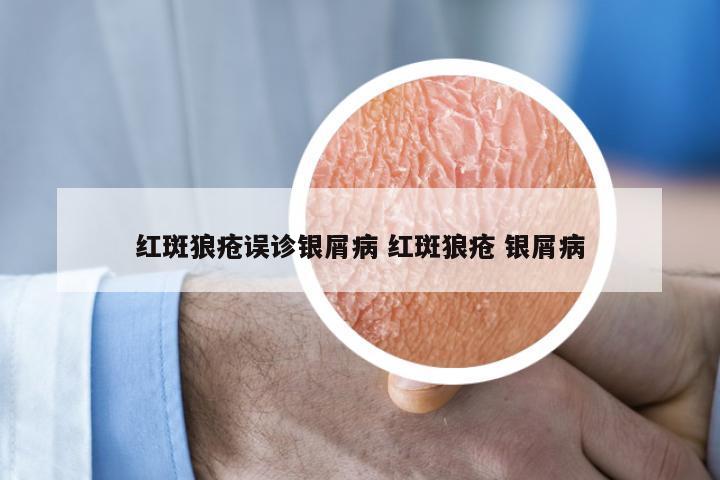 红斑狼疮误诊银屑病 红斑狼疮 银屑病