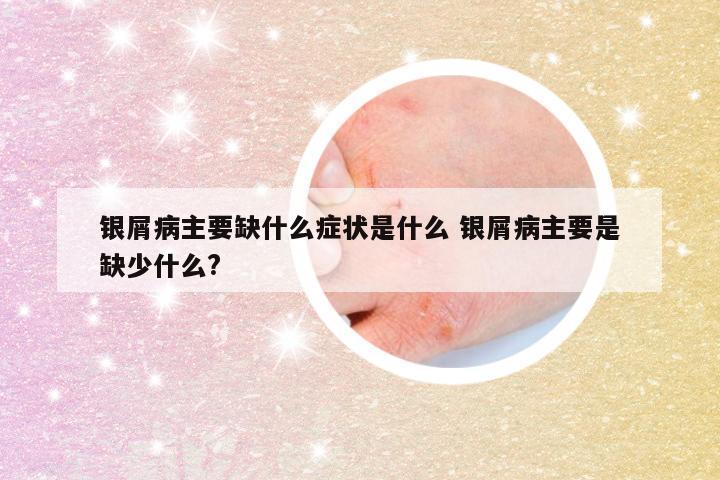 银屑病主要缺什么症状是什么 银屑病主要是缺少什么?
