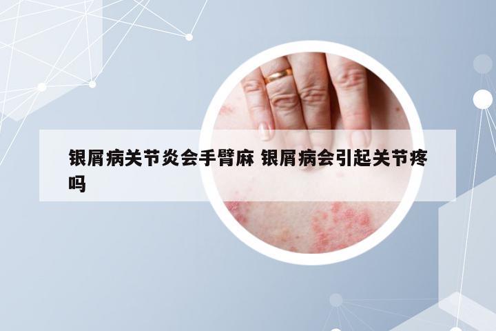 银屑病关节炎会手臂麻 银屑病会引起关节疼吗