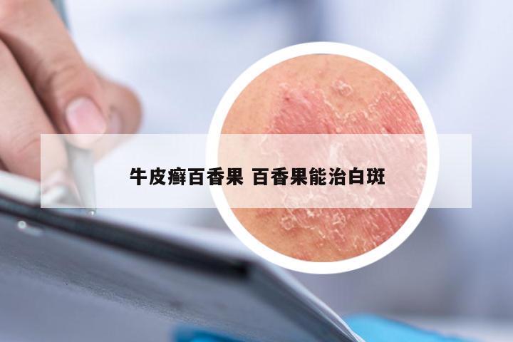 牛皮癣百香果 百香果能治白斑