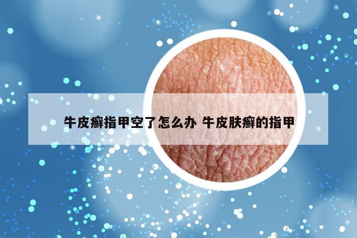 牛皮癣指甲空了怎么办 牛皮肤癣的指甲