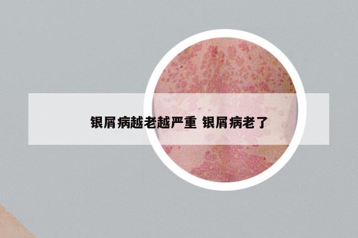 银屑病越老越严重 银屑病老了