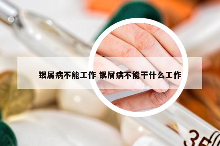 银屑病不能工作 银屑病不能干什么工作