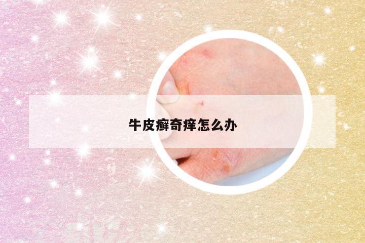 牛皮癣奇痒怎么办