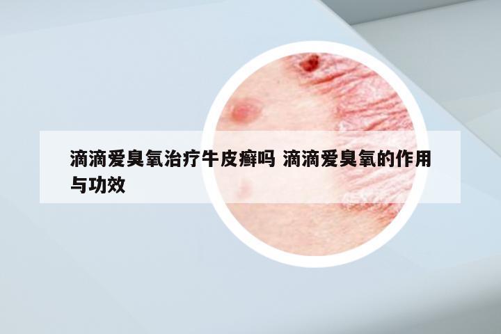 滴滴爱臭氧治疗牛皮癣吗 滴滴爱臭氧的作用与功效