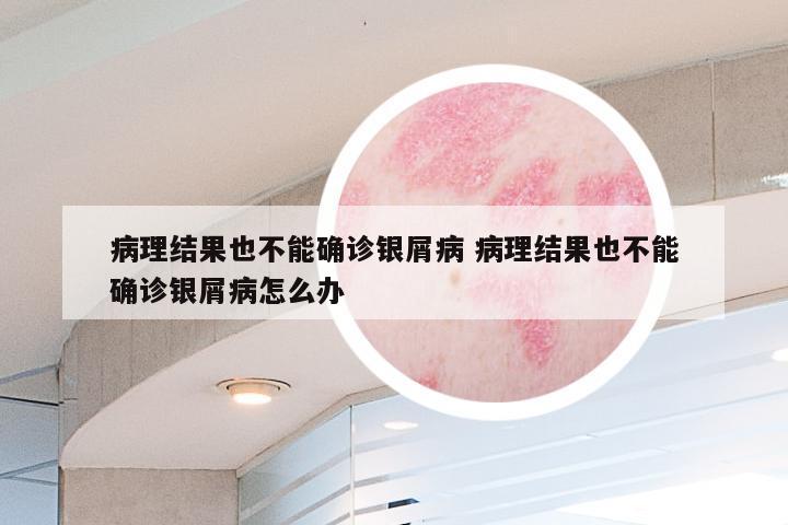 病理结果也不能确诊银屑病 病理结果也不能确诊银屑病怎么办