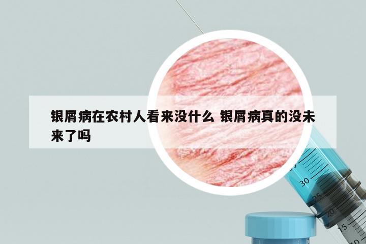银屑病在农村人看来没什么 银屑病真的没未来了吗