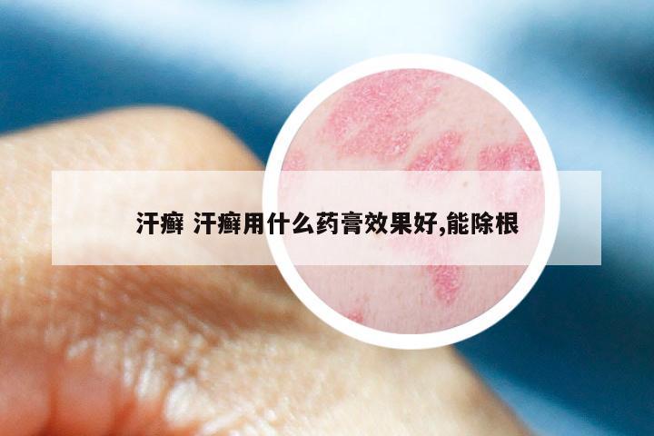 汗癣 汗癣用什么药膏效果好,能除根
