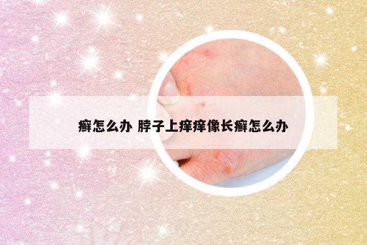 癣怎么办 脖子上痒痒像长癣怎么办