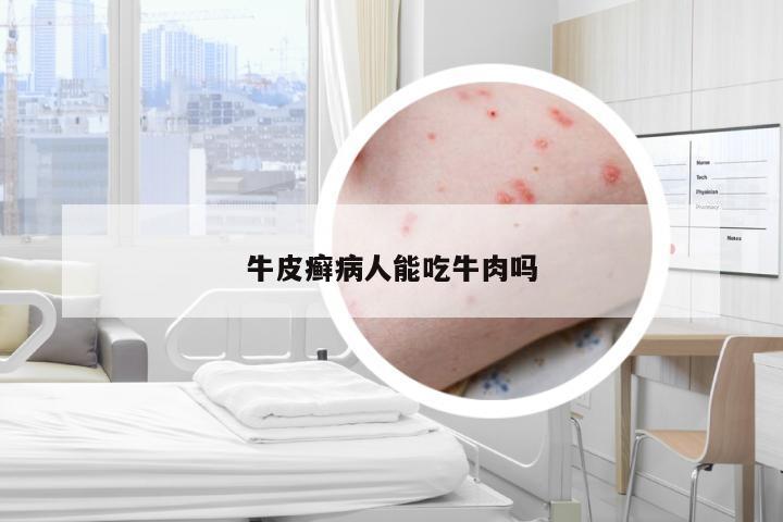 牛皮癣病人能吃牛肉吗
