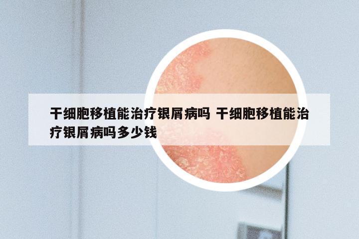 干细胞移植能治疗银屑病吗 干细胞移植能治疗银屑病吗多少钱