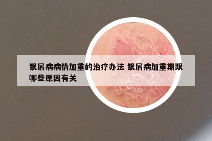 银屑病病情加重的治疗办法 银屑病加重期跟哪些原因有关