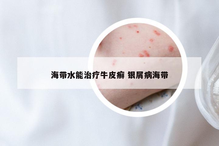 海带水能治疗牛皮癣 银屑病海带