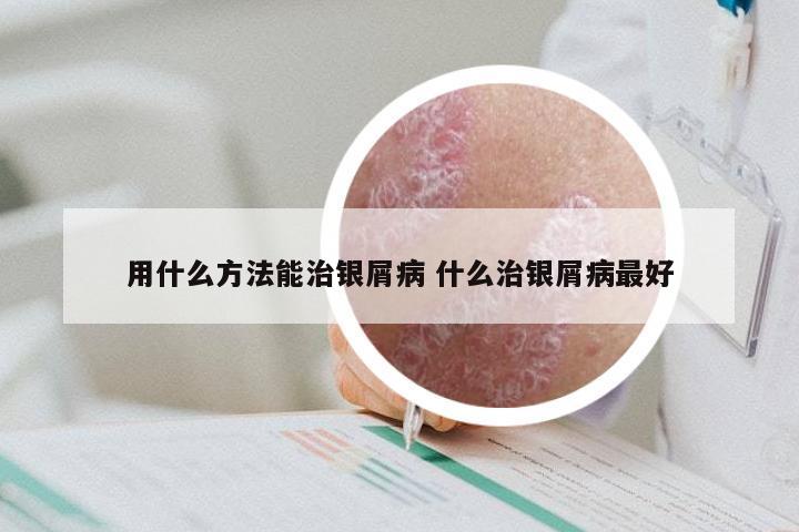 用什么方法能治银屑病 什么治银屑病最好
