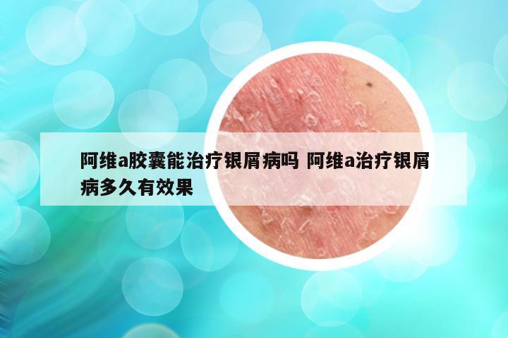 阿维a胶囊能治疗银屑病吗 阿维a治疗银屑病多久有效果