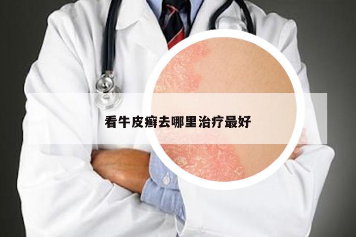 看牛皮癣去哪里治疗最好