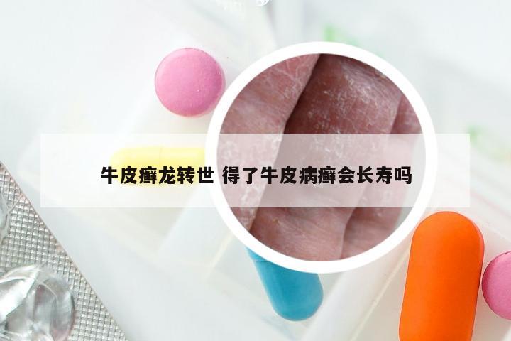 牛皮癣龙转世 得了牛皮病癣会长寿吗