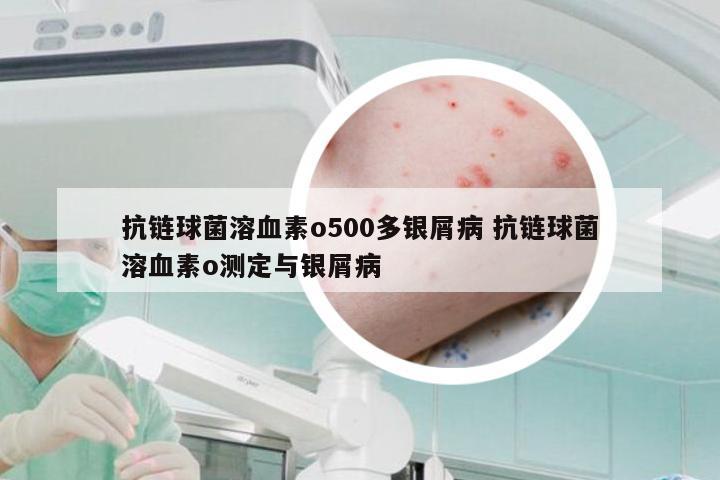 抗链球菌溶血素o500多银屑病 抗链球菌溶血素o测定与银屑病