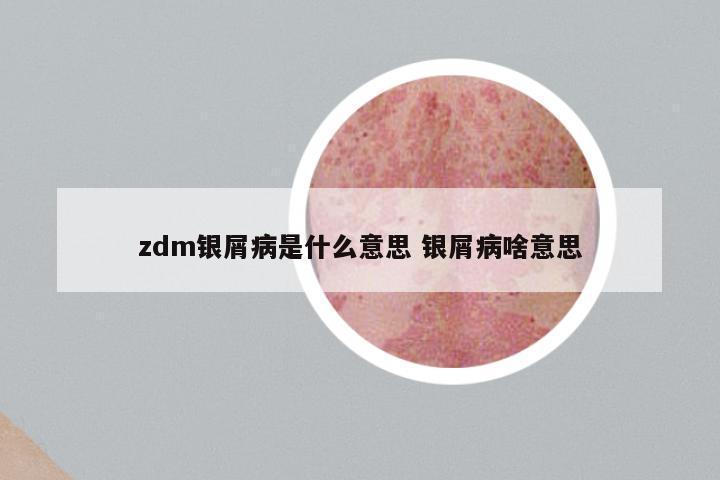 zdm银屑病是什么意思 银屑病啥意思