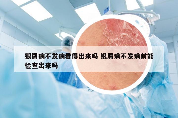 银屑病不发病看得出来吗 银屑病不发病前能检查出来吗