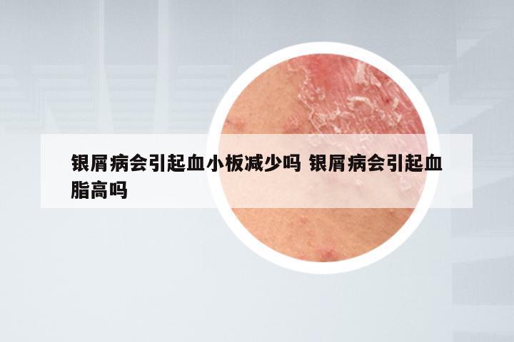 银屑病会引起血小板减少吗 银屑病会引起血脂高吗